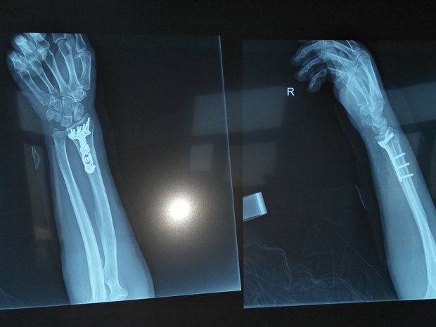我妈被人打倒右手手腕骨折,打了钢板钢钉;右边