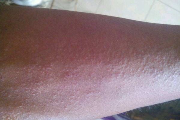 人对食物的过敏症为什么会随着时间的推移逐渐消失?