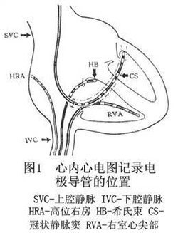 电生理检查的肌电图(emg)