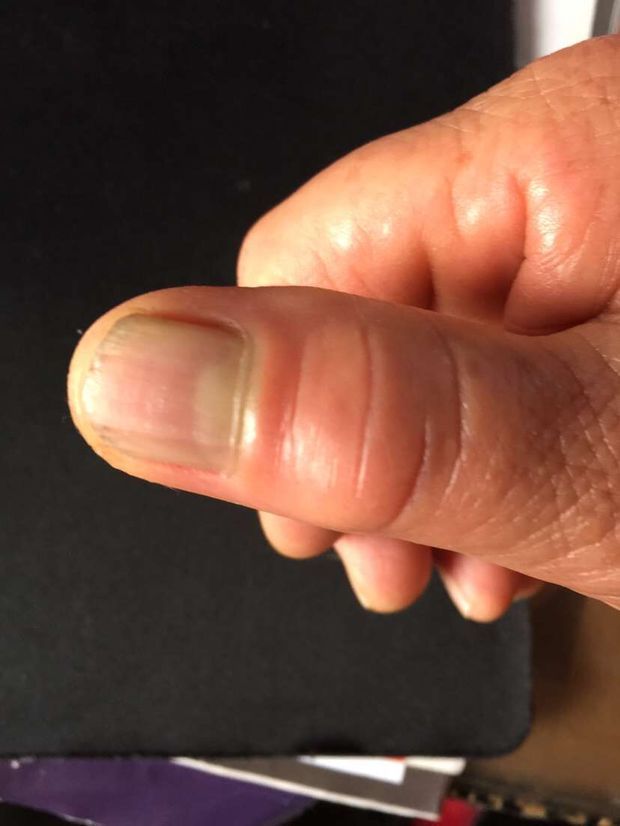 手指头莫名其妙的肿起来了!