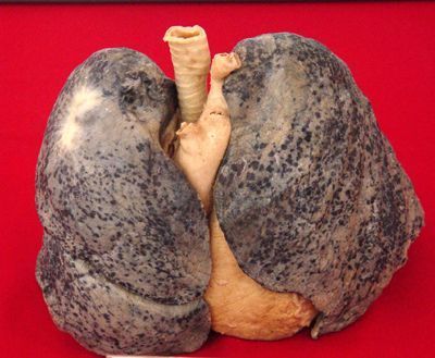 肺部图片 真实照片图片