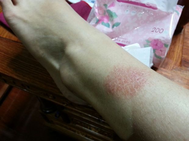 我的腿上有一块皮肤很干,像鱼鳞一样,是不是皮肤病啊?