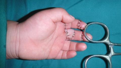 2岁女童玩钢 卷尺 两手指被严重割伤