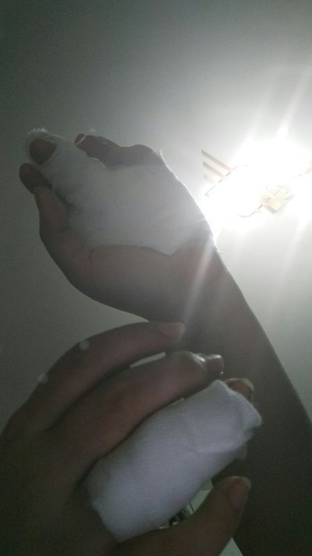 手受伤了在左手中指近关节处缝了一针,左手无