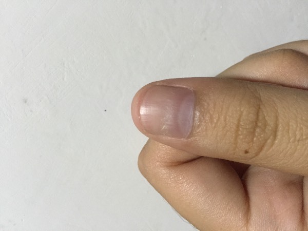 指甲分层,下层变厚且粗糙,是否暗示某种疾病