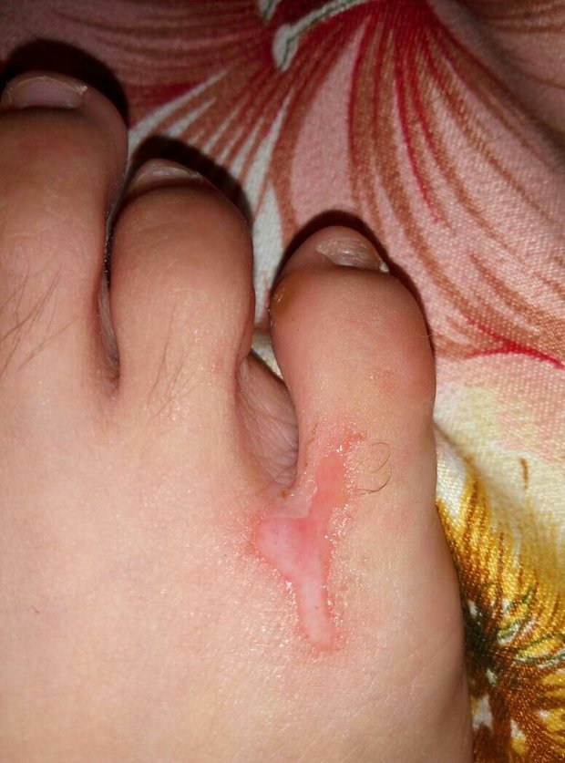 今天下午被热熔胶烫到脚,立马去冲了凉水,伤口现在变成这样了,问:是否