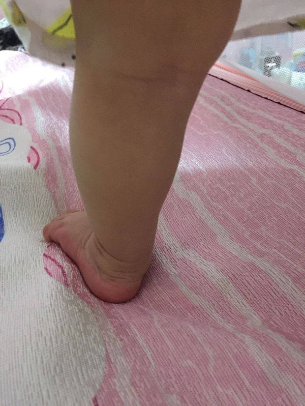 十一个月宝宝站起来脚是外八字,一侧的脚撇的比较严重,我查了查怕是足