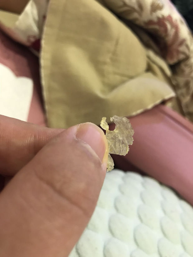 耳屎像皮一样,不是正常耳屎,像脱皮,请问怎么回事