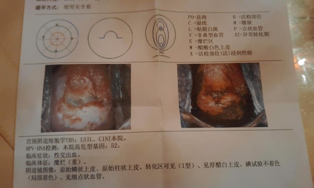 宫颈活检结果有几种