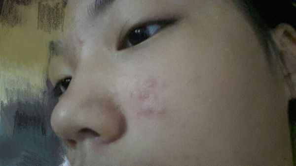 今天起来眼睛下方鼻子旁边突然长痘痘是怎么回