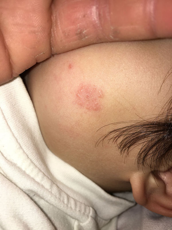 宝宝一岁半脸上被蚊子咬了 起了个这样包正常吗