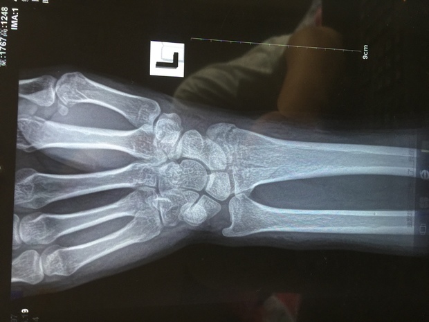 手腕骨折_手腕骨折护具