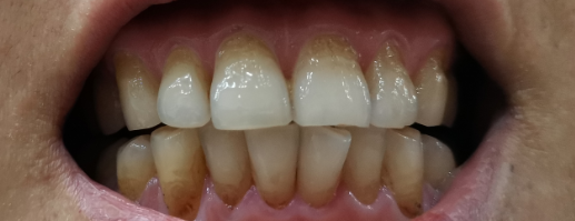 牙龈像是萎缩,牙根有点变黄变黑,并且不平有些点状坑(有照片),上下牙