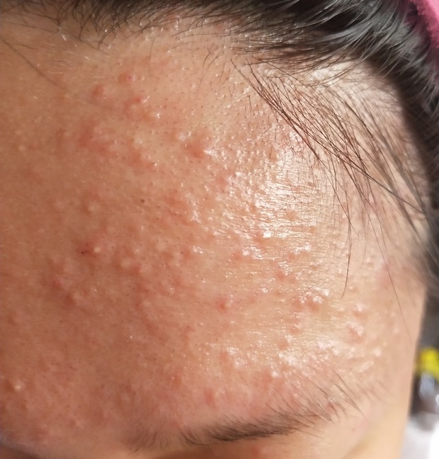 请问这是什么皮肤病