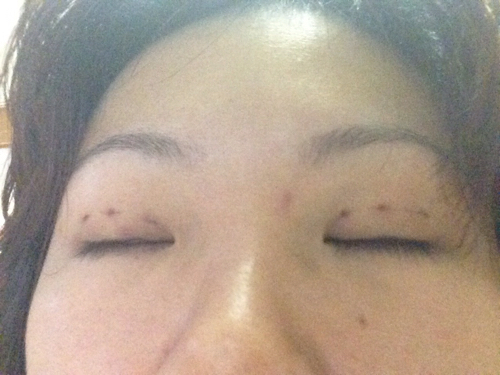 割双眼皮 拆线两天了 什么时候可以沾水 什么时