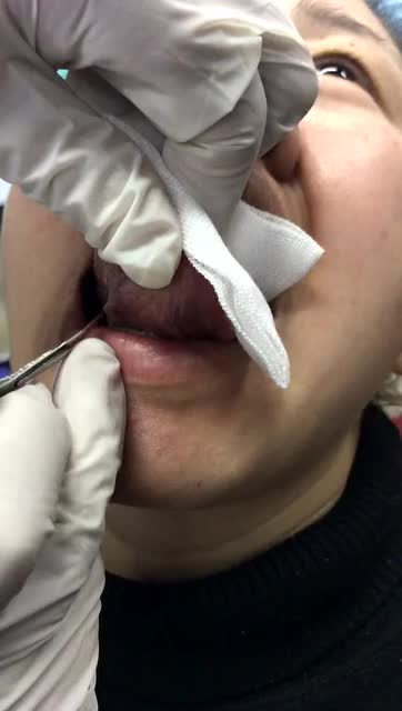 舌下取血栓图片