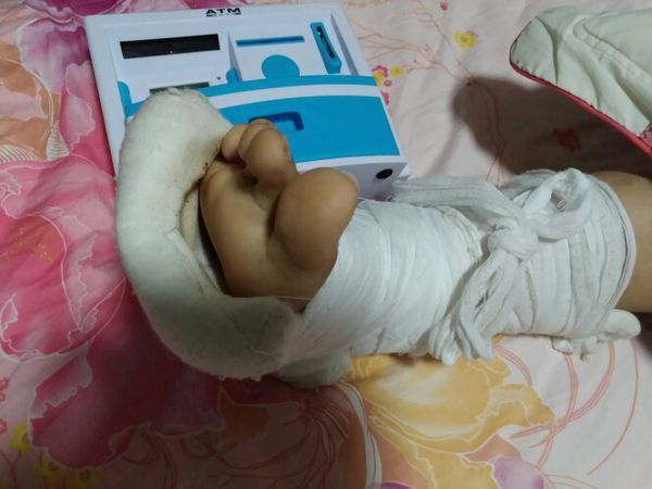 请问我左脚崴骨折了打了石膏,10天以后绷带松了,我绑了一下,请问需要