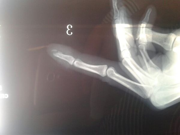 我是工伤、手指中指开放性骨折并甲床裂上,上