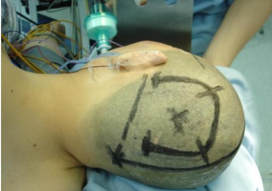 脑疝是什么意思