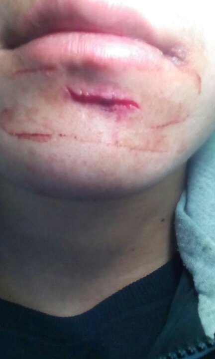 下巴磕到了,应该怎么办