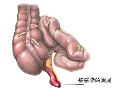 六小龄童所患的急性阑尾炎是什么病?