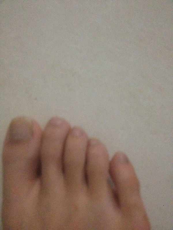 打篮球脚崴了,一回家被活络油搓,搓完外敷了生