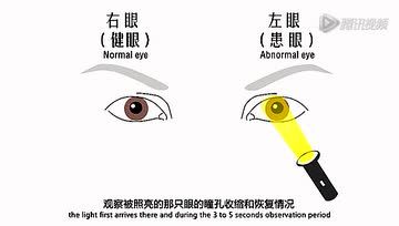 [图]眼科临床常规检查方法 - 4瞳孔检查