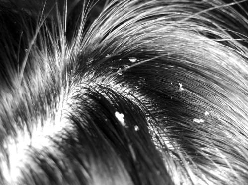 头皮屑越洗越多