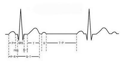 心电图等电位线消失图片