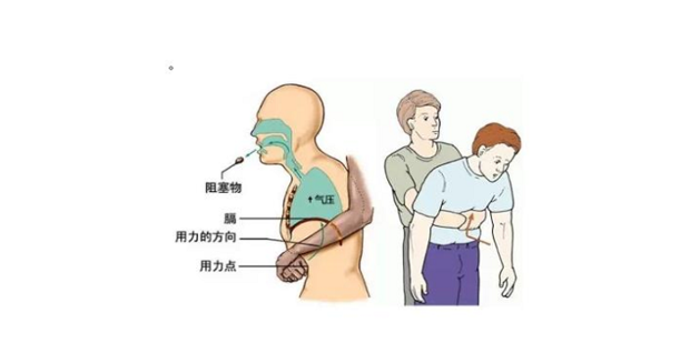 海姆立克急救法步骤详解360新知 4753