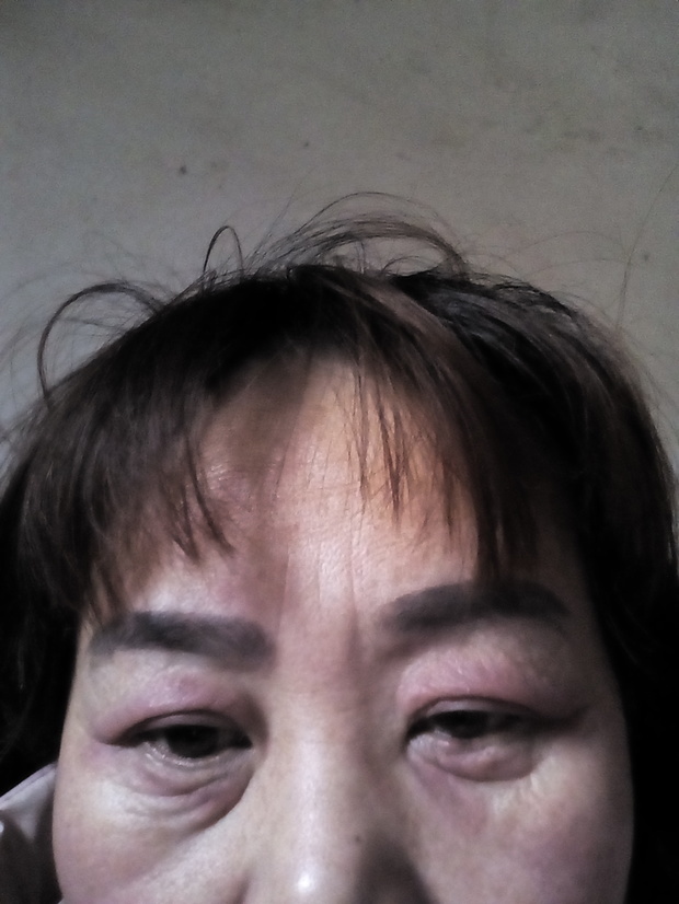 肿的原因有很多,比如不当的使用化妆品,皮肤病,心,肾功能不全,血管