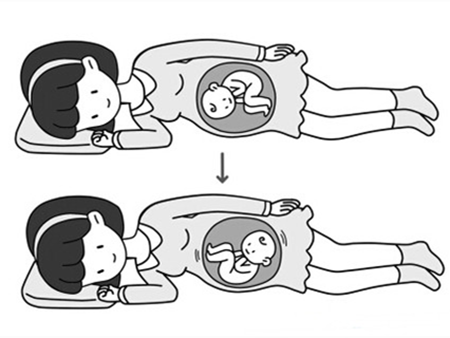 胎儿头位和臀位的区别