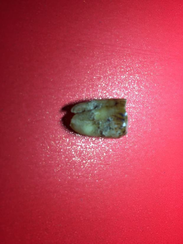 我的大牙掉了不知道是什么原因