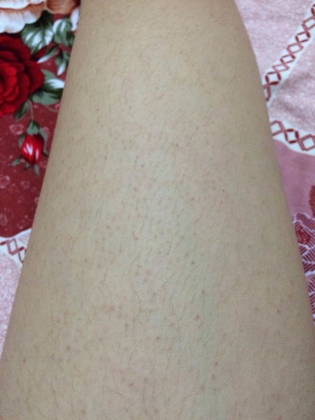 鸡皮肤怎么消除