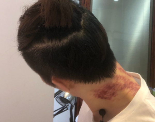 刮完痧后不能碰冷水,是指刮出痧的地方不能碰冷水还是连手也不能碰到