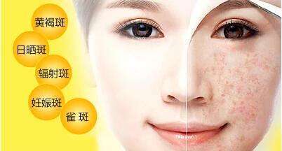 脸上长了斑 ,怎么区分是什么斑