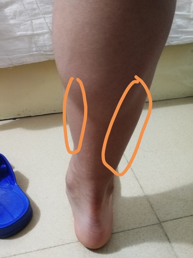 我小腿这个肌肉的两侧很粗,应该怎么减?有图片.