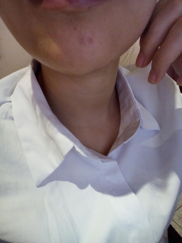 额头上下巴长小米粒疙瘩,痘痘!