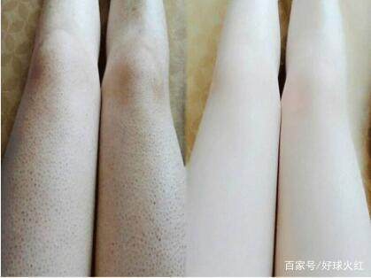 小女孩鸡皮肤基因(鸡皮肤如何不遗传孩子)