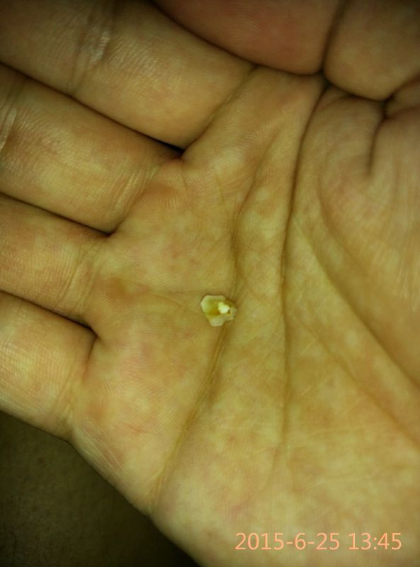 去年补了一颗牙。做了根管治疗后填充了树脂,