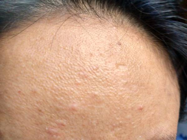 请问大家知不知道额头上类似于鸡皮疙瘩的这种东西是什么?怎么祛除呢