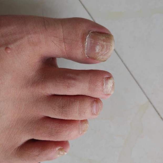 脚指甲发白,脚趾间起皮痒脚也有臭味,什么引起的,怎么治除根