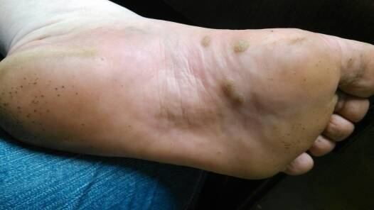 这什么东西我脚上长的大颗的可能是跖疣那么小黑点一样的东西是什么呢