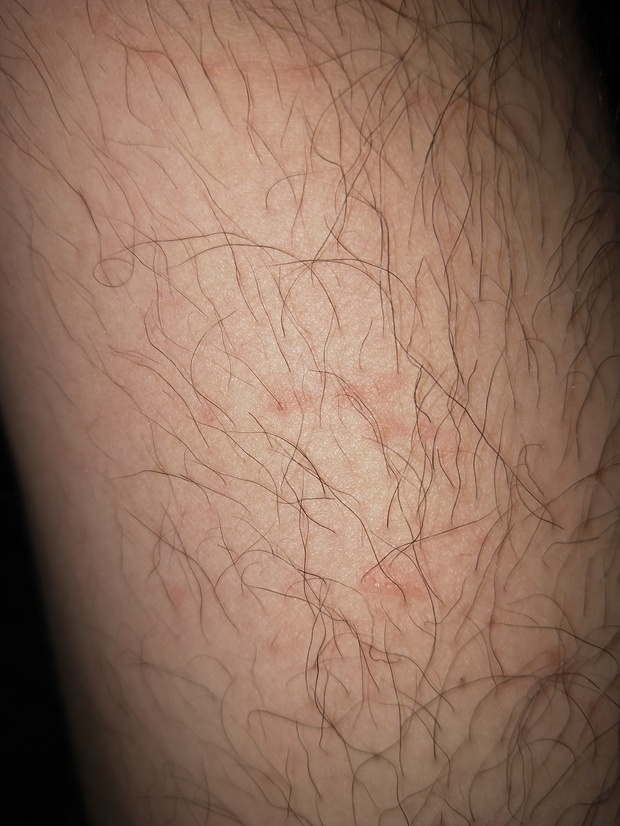 被小野猫抓伤了