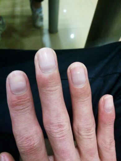 手指甲从月牙处发黑,没月牙的左手无名指没有