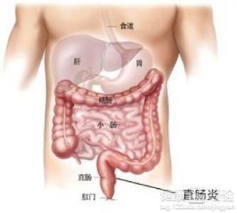 直肠炎