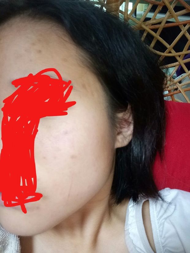 请问这是痘印还是痘坑?可以自己消失吗?