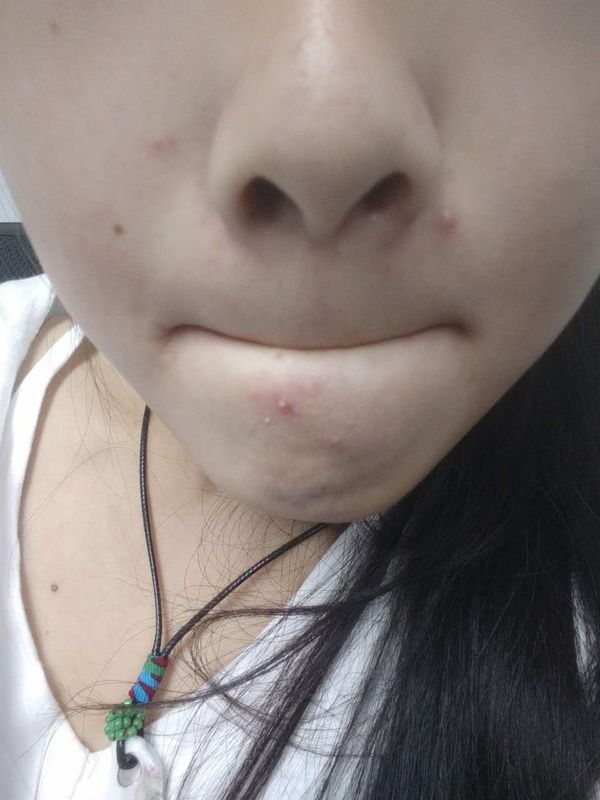 这几天一直长痘痘,怎么办呀,鼻子旁边的那颗很痒.受不了.